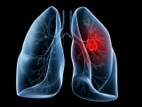 lung-cancer13